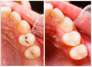 Composite Tooth Fillings