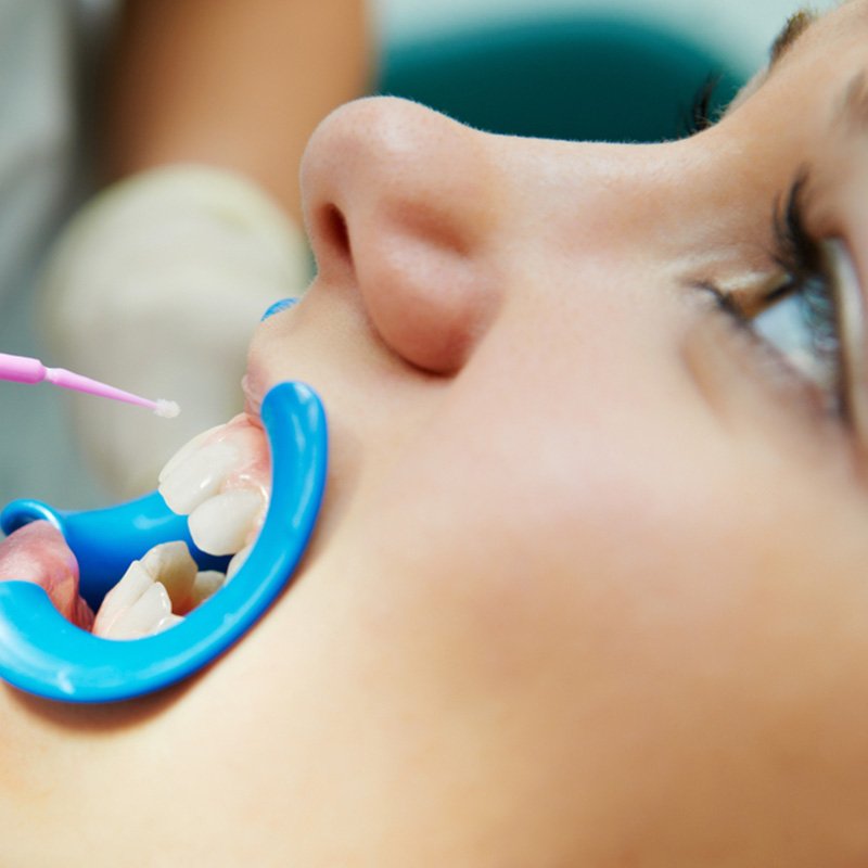 Dental Sealants St. Louis, MO Perfect Smiles STL