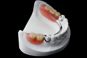 Partial Denture