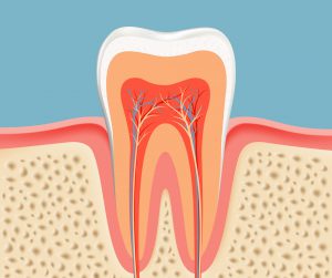 Root Canal