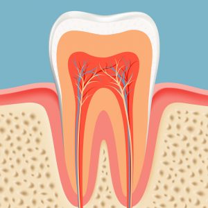 Root Canal